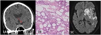 Cerebral Large Vessel Occlusion Caused by Fat Embolism—A Case Series and Review of the Literature